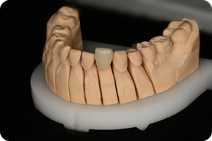 Porcelāna zobu venīra paraugs uz zobu modeļa pirms uzlikšanas un smaida korekcijas