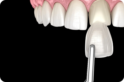 Porcelāna venīra uzlikšana uz priekšzobiem estētiskai smaida korekcijai