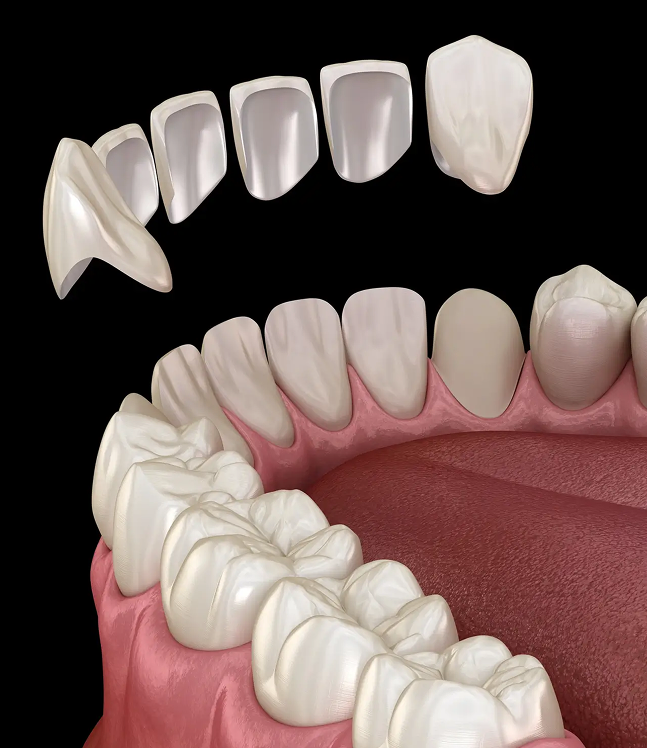 Porcelāna zobu venīri dažādos izmēros un venīru uzlikšanas process uz priekšējiem zobiem